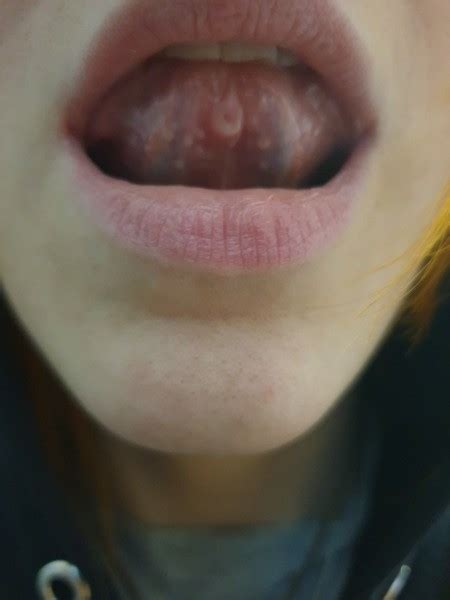 Is My Tongue Piercing Infected Thriftyfun