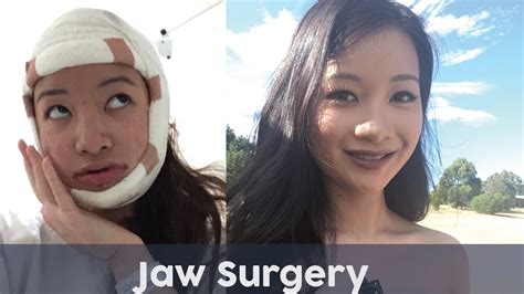 My Double Jaw Surgery Experience Youtube