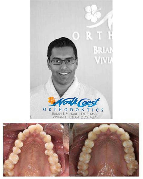Ordered dumpling soup noodles, and steamed daun teratai chicken rice. A look back at an awesome #Invisalign case done by Dr ...