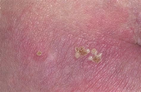Herpes blisters and sores on the buttocks. What is Herpes Pictures - 33 Photos & Images / illnessee.com