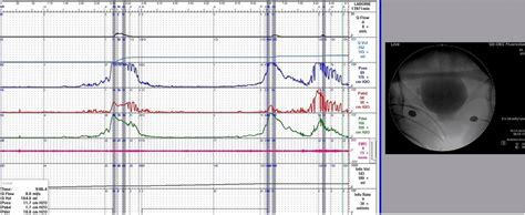 Videourodynamic Study Of Dysfunctional Voiding In A Woman With An Open