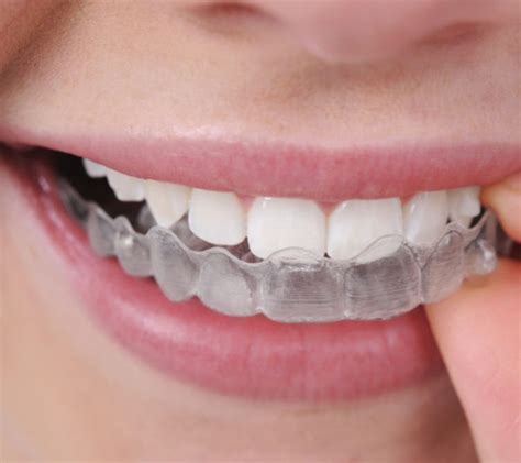 Invisible Braces In Nagpur Invisalign Braces In Nagpur Dr Jamila