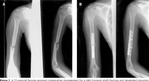 Surgical Treatment Of Humeral Shaft Fractures Orthopaedicprinciples Com