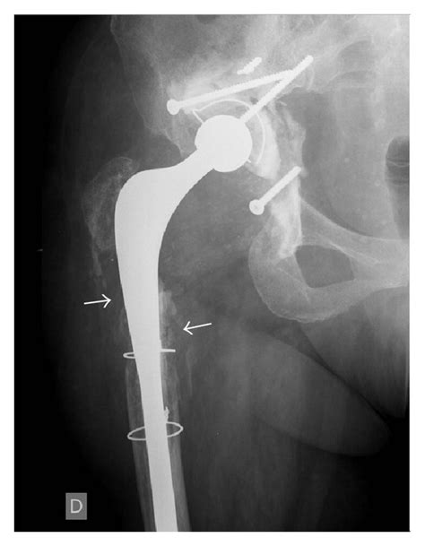 X Ray Of Total Hip Arthroplasty Showing Extensive Lytic Lesions Around
