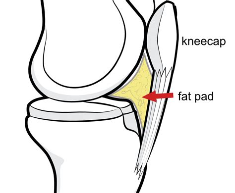Patellofemoral Pain Syndrome Kneeguru
