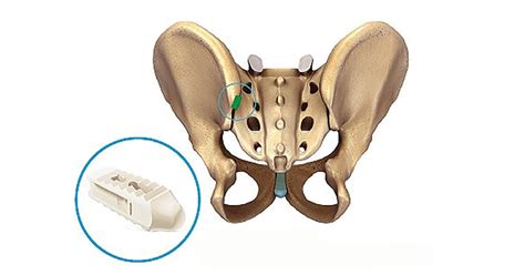 Minimally Invasive Sacroiliac Joint Fusion Provides Fast Recovery