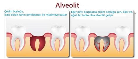 ¿qué Es La Alveolitis Síntomas Y Tratamiento De La Alveolitis Después