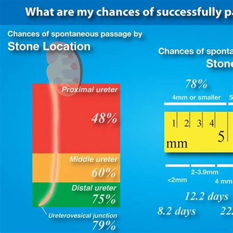 Stages Of Passing Kidney Stones Kidney Stones Clinic