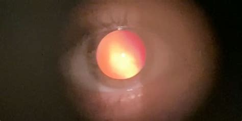 Retinoscopy Findings In Keratoconus American Academy Of Ophthalmology