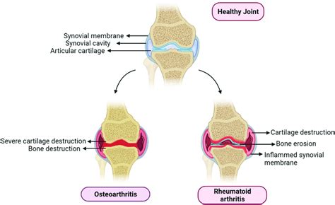 Representation Of The Basic Differences Between Osteoarthritis And Download Scientific Diagram