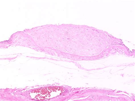 Amnion Nodosum Placenta Histology