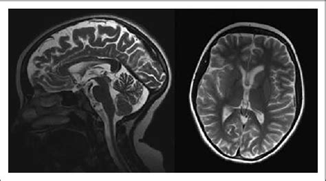 Brain Magnetic Resonance Imaging Mri Of The Patient Performed At The