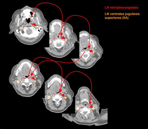 Lymph Regions And Drain Contoured In Transversal Ct Slices Ln