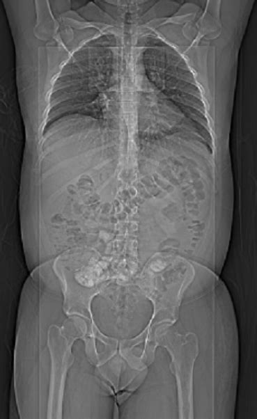 Thorax And Abdomen CT Scan