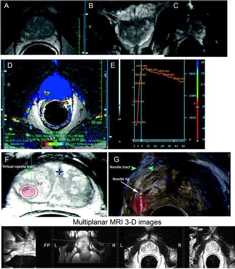 Multiparametric Magnetic Resonance Imaging Approaches In Focal Prostate