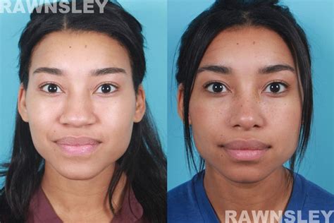 African American Rhinoplasty Before And After 1 Rawnsley Plastic