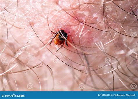 Mite Under The Human Skin Royalty Free Stock Photo