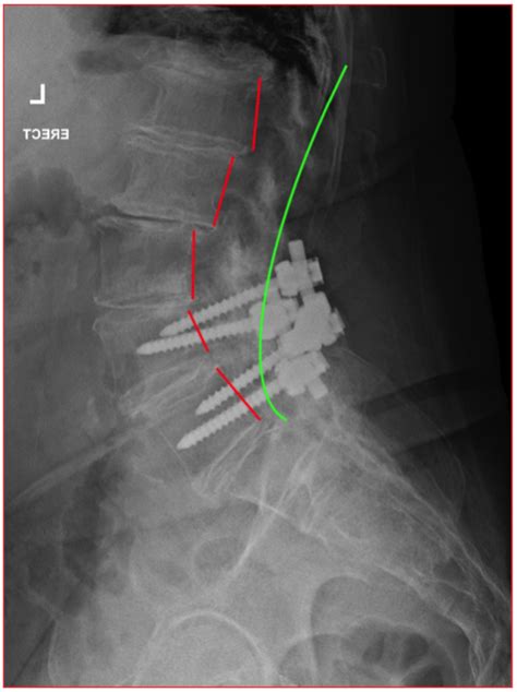 Case History Failed Back Surgery The Spinal Centre