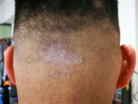 Ringworm What Are The First Symptoms And Treatments Earth Press News