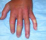 Scleroderma Mayo Clinic Images