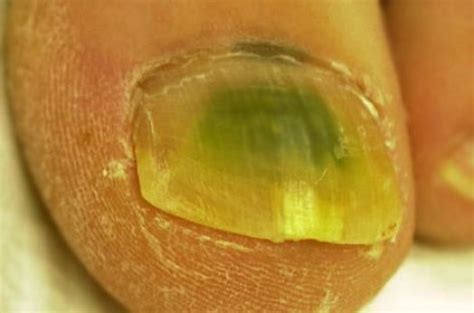 Black Toenail Cancer Things You Must Know Nedufy