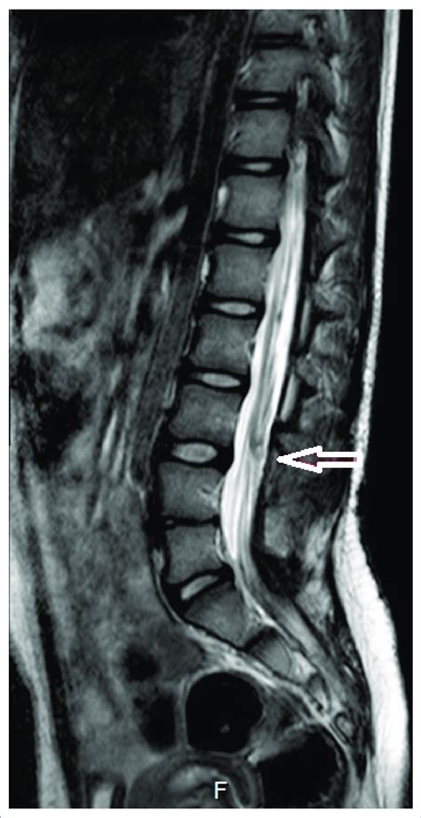 Spinal Cord Terminates At The Level Of Inferior Endplate Of L3 Vertebra