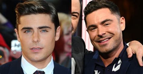 zac efron plastic surgery accident did he have a facial accident