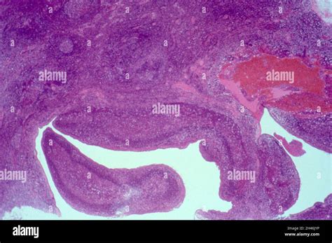 Parotid Gland Lymphoepithelial Cyst With Hiv Stock Photo Alamy