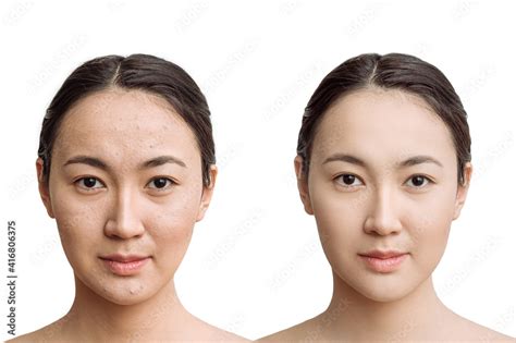 The Concept Of Skin Care Before After Young Asian Woman With Bad Skin