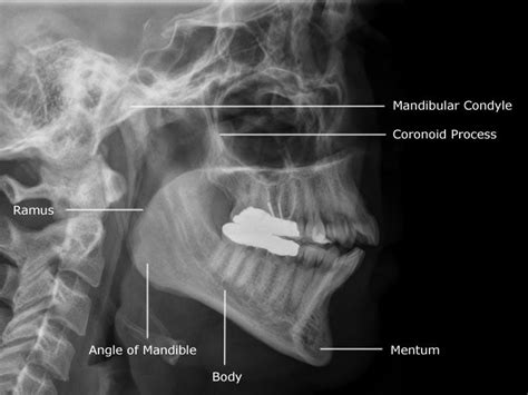 Radiographic Anatomy Of Facial Bones And Mandible With Radiological