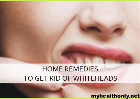 15 Tremendous Home Remedies For Whiteheads My Health Only