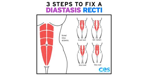 3 Steps To Fix A Diastasis Recti Core Exercise Solutions