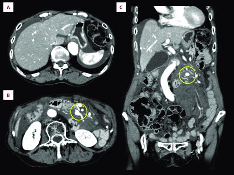 Ct Scan Showing A Fluid Collection In The Both The Subphrenic And