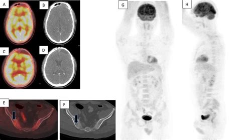 Fused Fdg Petct A And C Cect Transaxial Images Of Brain