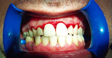 Maybe you would like to learn more about one of these? This is How To Heal Gum Disease In a Week (Or Less ...