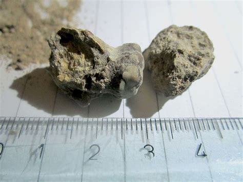 Giant Kidney Stone Stuck Inside Mans Body For Two Months Nature