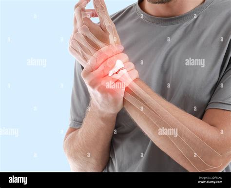 Young Man With Broken Wrist Suffering From Pain On Color Background