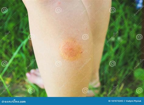 Mosquito Bite On The Leg Insects In The Summer Dangerous Nature Stock