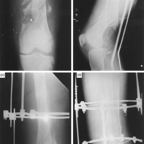 Pdf The Ilizarov Method In Infected Nonunion Of Fractures