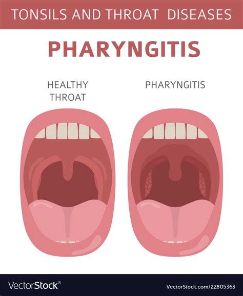 Tonsils And Throat Diseases Pharyngitis Symptoms Vector Image