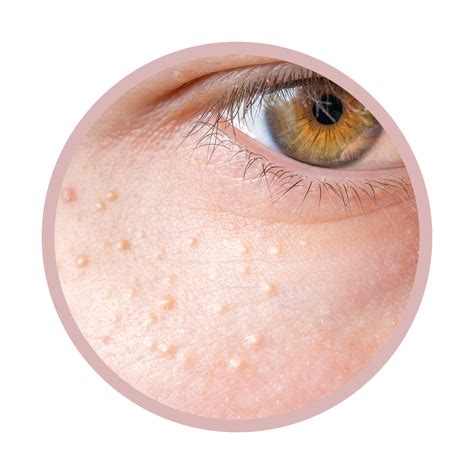 How To Get Rid Of Milia Those Pesky Unpoppable White Bumps