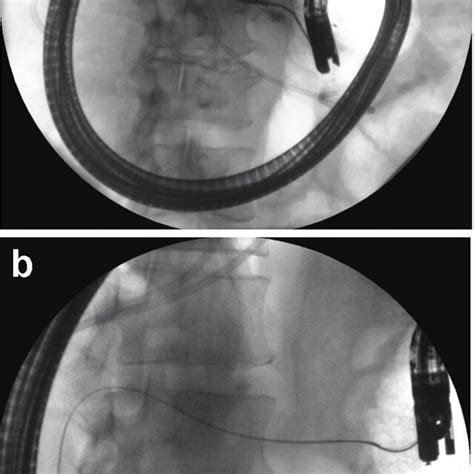 A The Endoscopic Retrograde Pancreatography Reveals Complete