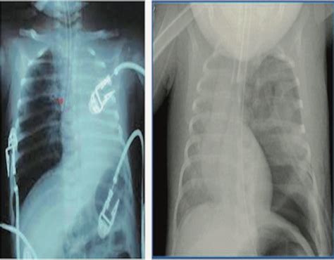 X Ray On The Left Shows A Misplaced Endotracheal Tube Which Is In The Download Scientific
