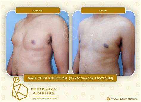 How To Shape Chest After Gynecomastia Surgery Tialesharai