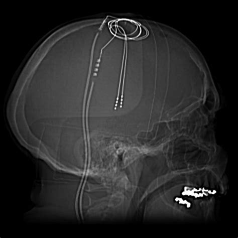 New Technique For Deep Brain Stimulation Surgery