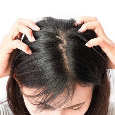 How To Treat Scalp Zits According To Experts Scalp Treatment