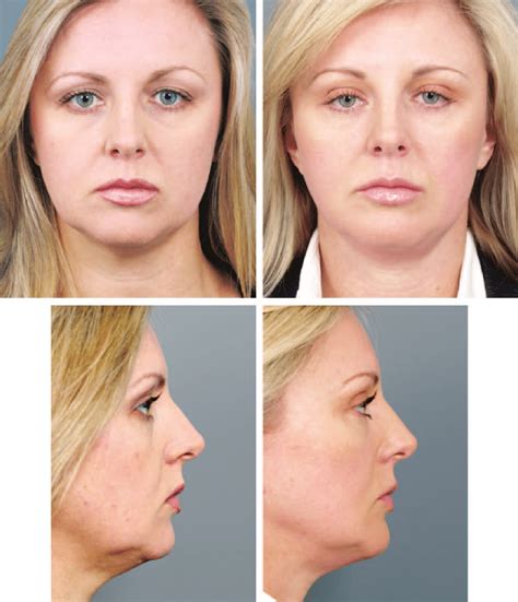 Patient Series Showing The Results Of Three Procedures Over 13 Years