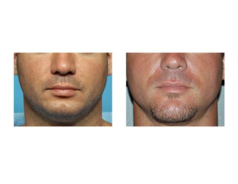 Blog Archivecase Study Vertical Lengthening Of The Short Chin By