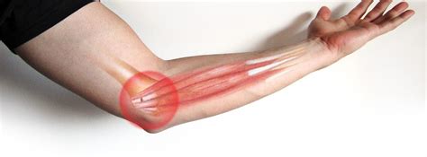 7 Awesome How To Relieve Tendonitis Pain In Elbow Latest