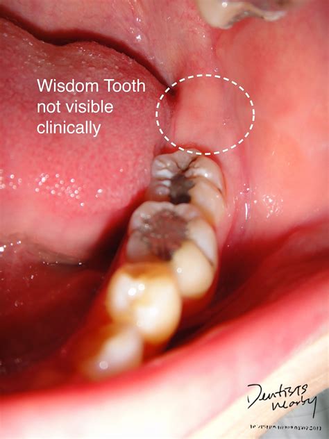 Things To Know About Wisdom Tooth Removal Dr Siddharth Dhanaraj